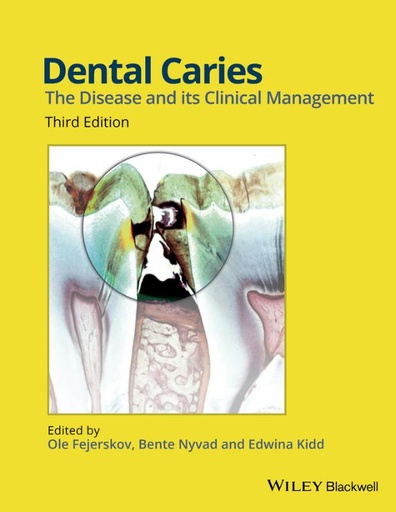 [9781118935828] Dental Caries / 3th edition